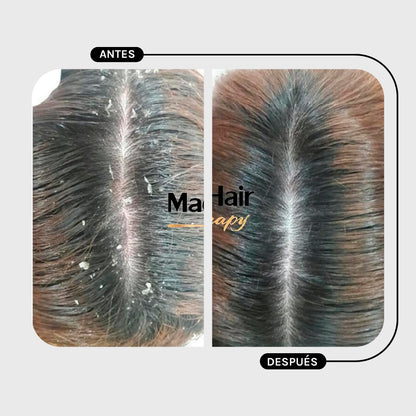 Shampoo Caspa